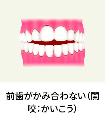 歯の予防