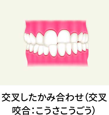 歯の予防