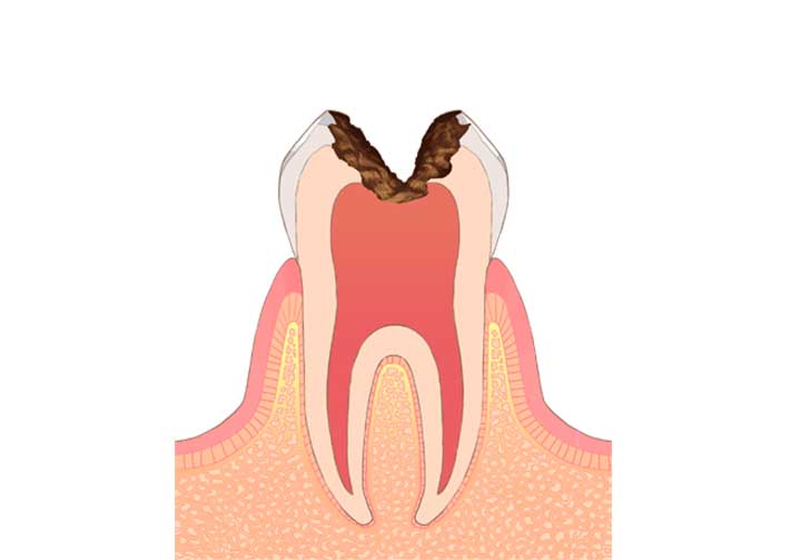 C3(シースリー)：神経に達する虫歯