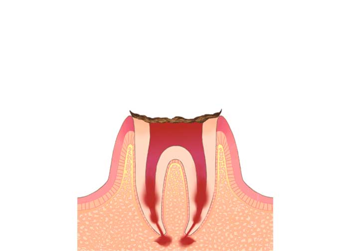 C4(シーフォー)：歯がほとんど崩壊した状態
