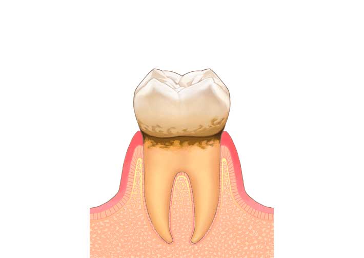 歯肉炎