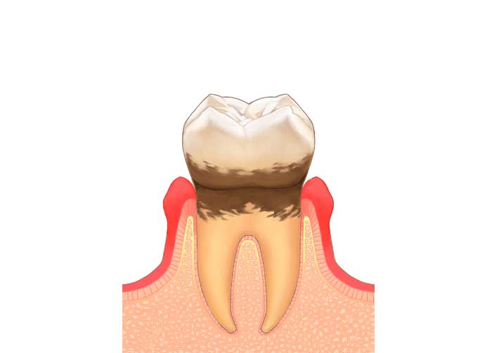 軽度歯周炎