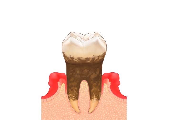 中等度歯周炎
