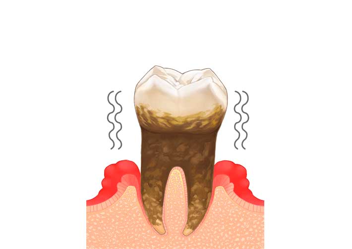 重度歯周炎