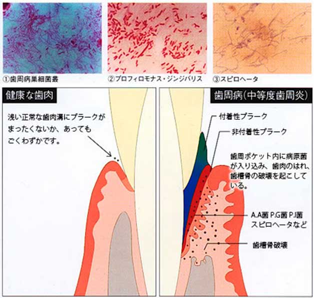 歯周病の発症