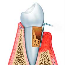 歯周病の進行
