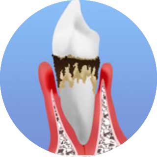 歯周炎中期