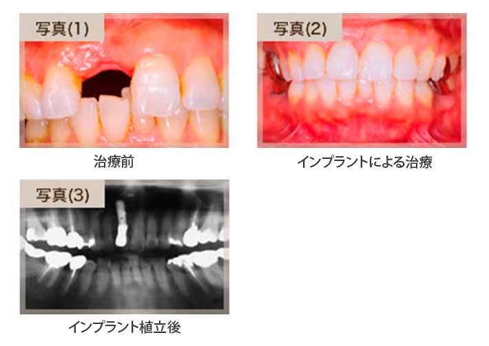 ブリッジをせずにインプラントで治療したケース