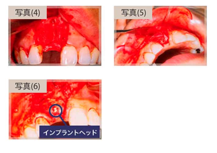 骨が少ない部分に骨を増やしてインプラントを行ったケース