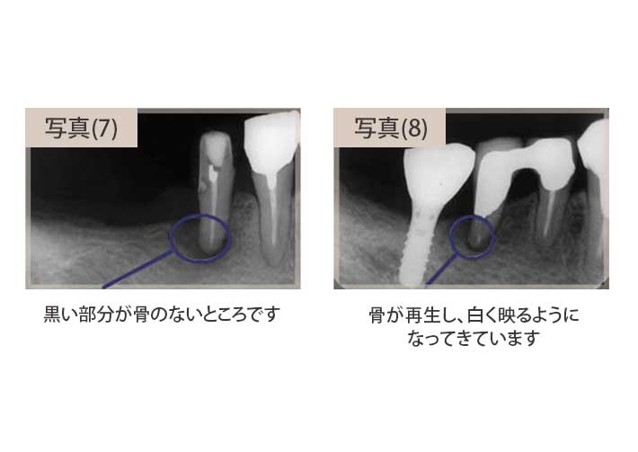 抜歯を避けるためにインプラントを行ったケース