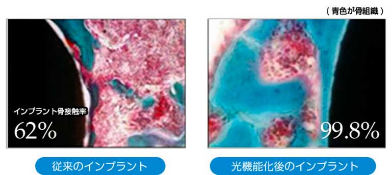 静脈内鎮静法とは